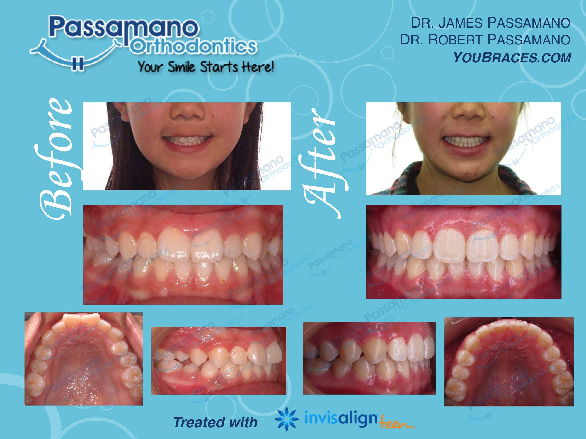 Smile About Introducing Invisalign Teen 32